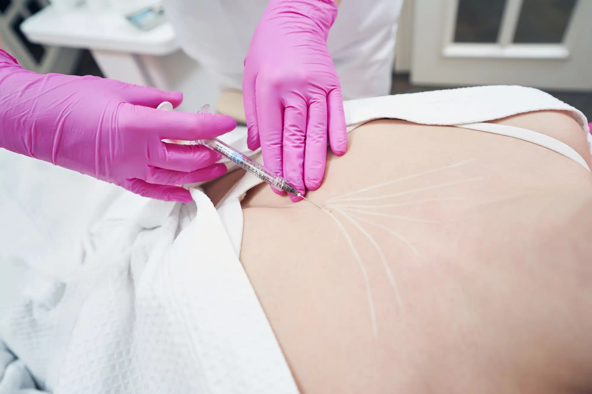 Kök hücre tedavisi